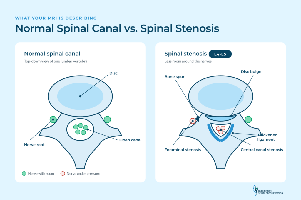 Medical illustration comparing a normal spinal canal with spinal stenosis at L4-L5, showing nerve compression and narrowing described in an MRI report.